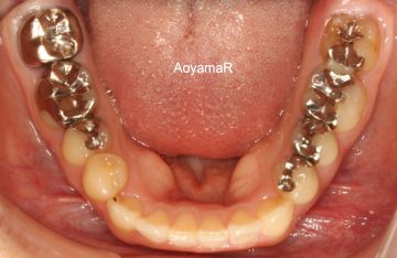 上顎両側側切歯が矮小歯による空隙歯列