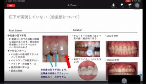 invisalign stepup